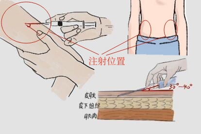 皮内针注射方法和位置图片 | 百度健康·医学科普