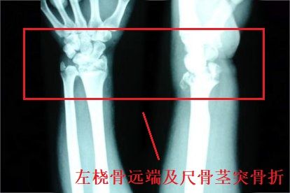 左桡骨远端及尺骨茎突骨折图片