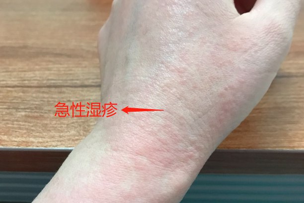 过敏性皮炎图片和症状图 | 百度健康·医学科普