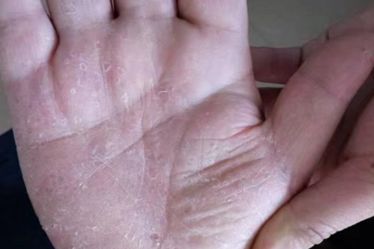水疱型手癣手掌脱皮图片