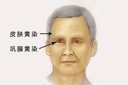 梗阻性黄疸图片