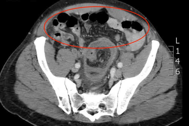 肠梗阻CT三层肠壁征图