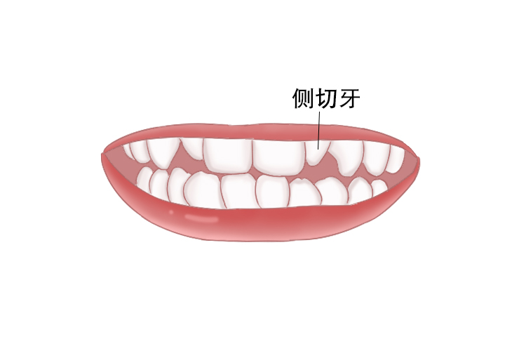 门牙两边的牙小图片