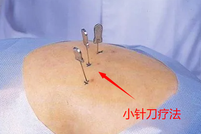 小针刀疗法示意图