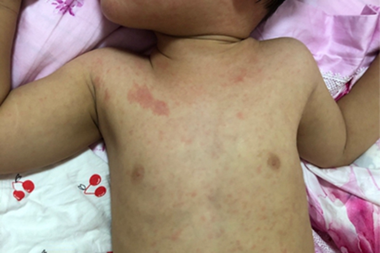 幼儿急疹 | 百度健康·医学科普