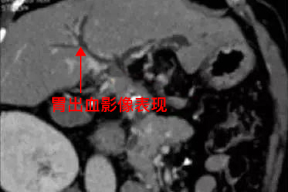 胃出血CT图片大全