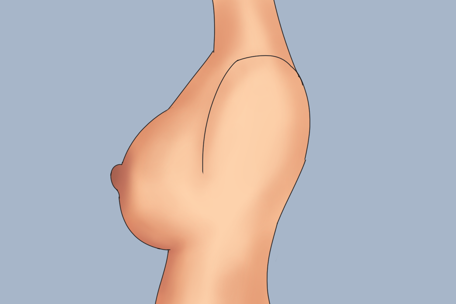 圆锥型乳房图
