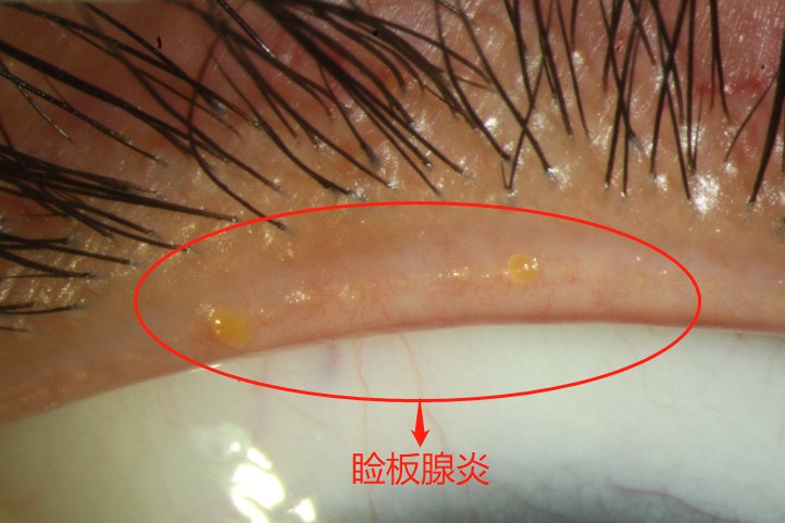 眼睑炎和麦粒肿的区别图片