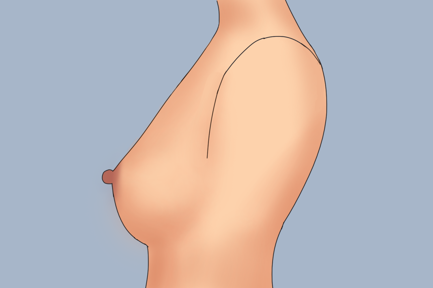 扁平型乳房图