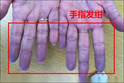 心脏病皮肤症状图片