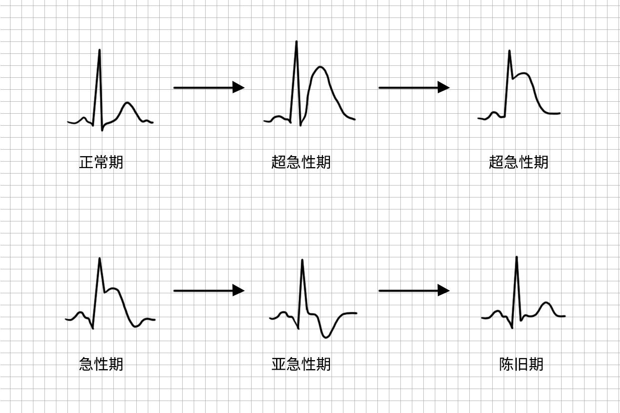 急性心肌梗死T波高耸图片