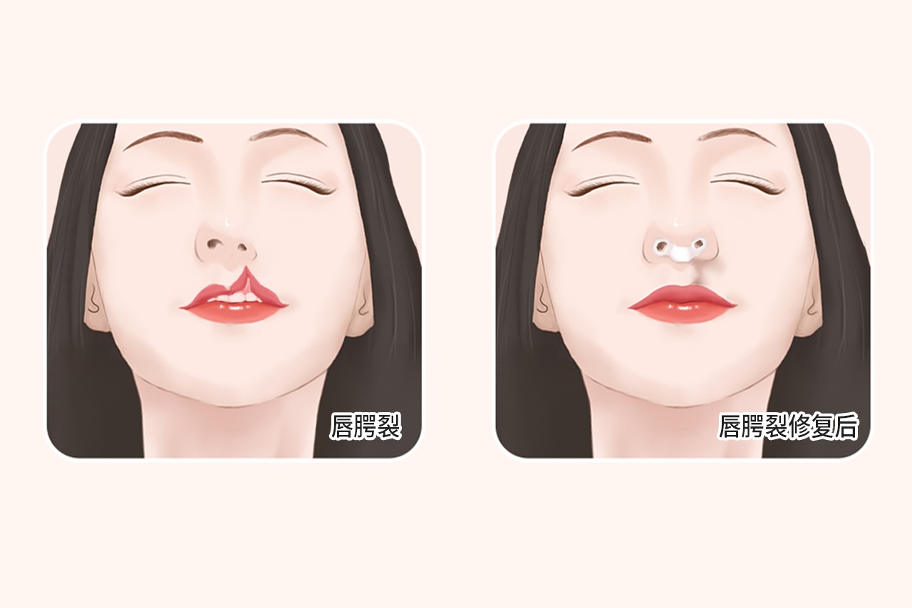 唇腭裂鼻子整容效果图 | 百度健康·医学科普
