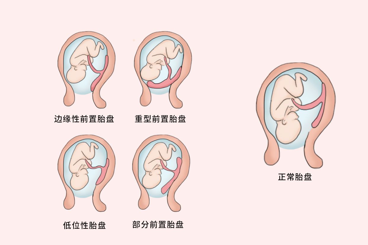 胎盘位置低导致出血,一般什么时候能好