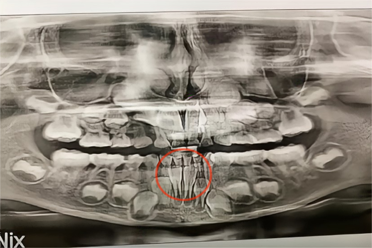 儿童乳牙滞留牙片图