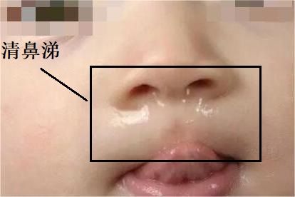 黄鼻涕和清鼻涕图片 | 百度健康·医学科普