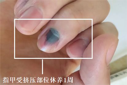指甲内挤压伤需要几天恢复正常图片