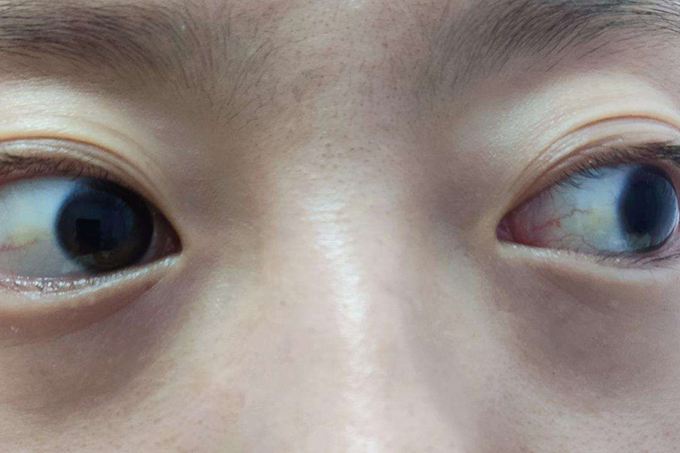 黄疸早期或轻微出现时常见的部位是哪里