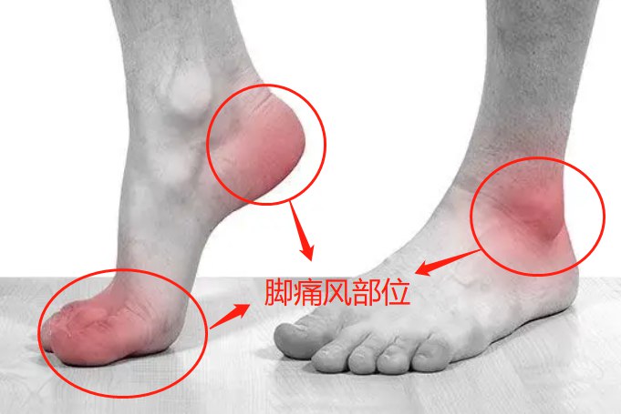 痛风脚疼位置图片 | 百度健康·医学科普