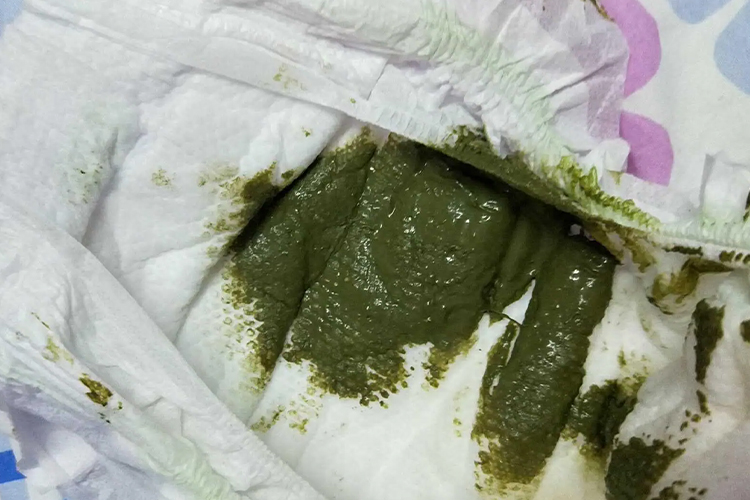 宝宝墨绿色大便图片 | 百度健康·医学科普