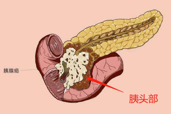 胰胁癌好发部位 | 百度健康·医学科普