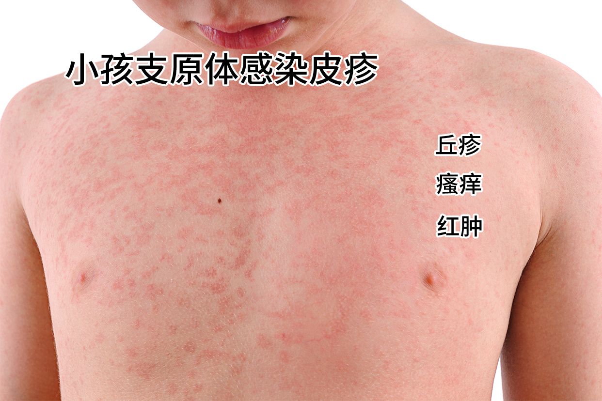 小孩支原体感染皮疹图