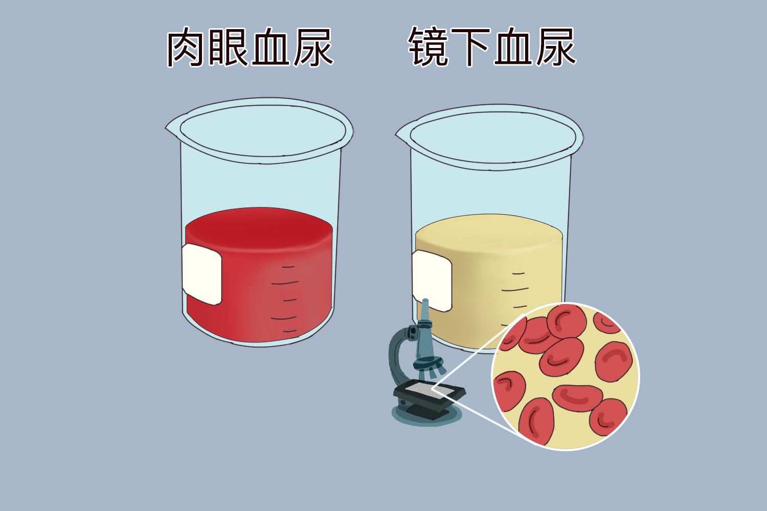 血尿是什么颜色及图片 | 百度健康·医学科普