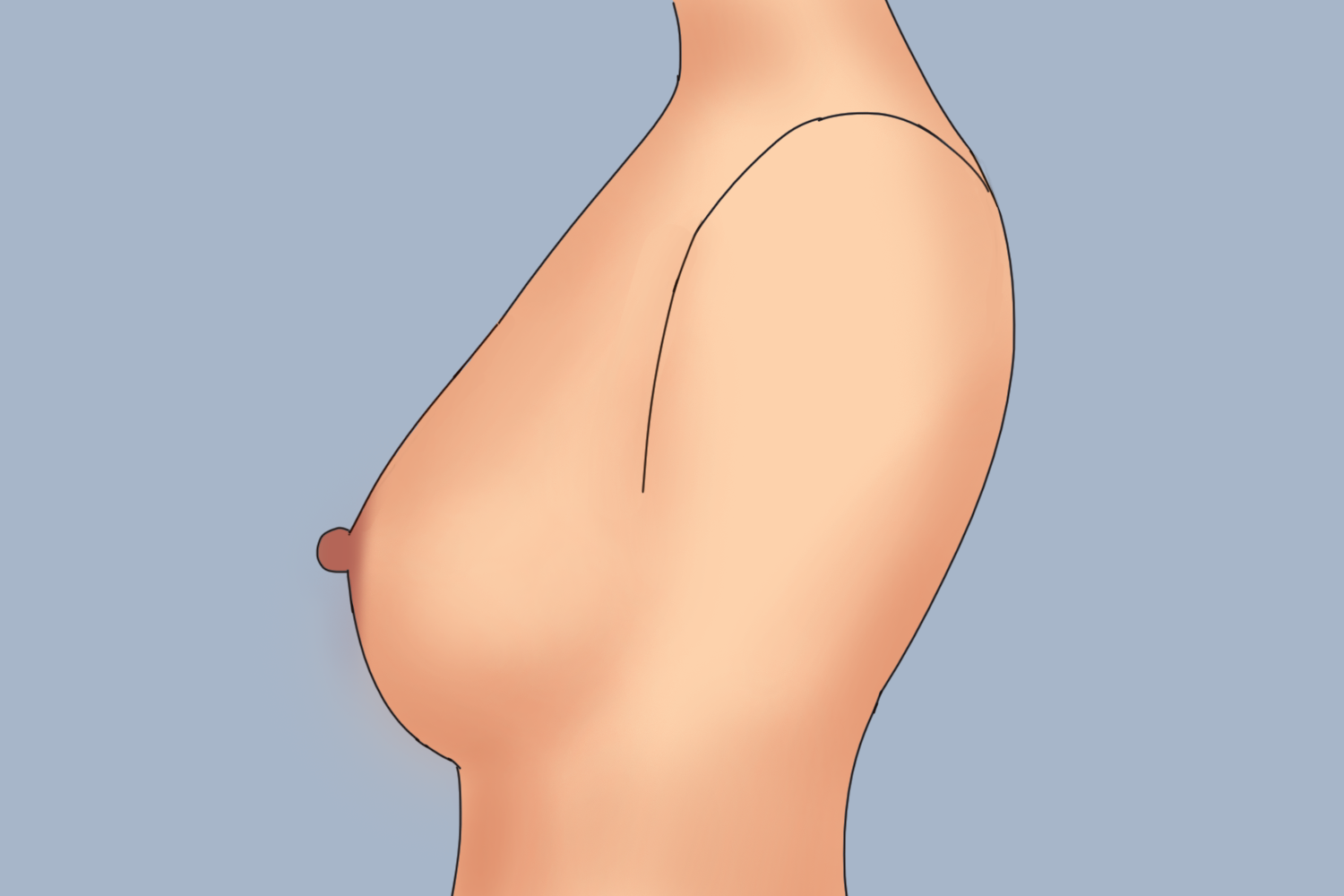 圆盘型乳房图