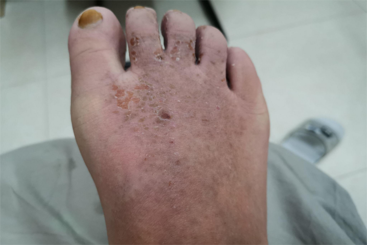 慢性湿疹脚背黑痂图片