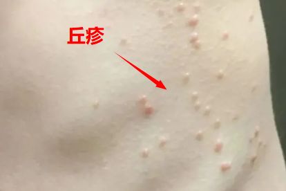 皮肤上各种疹子的图片和名称 | 百度健康·医学科普