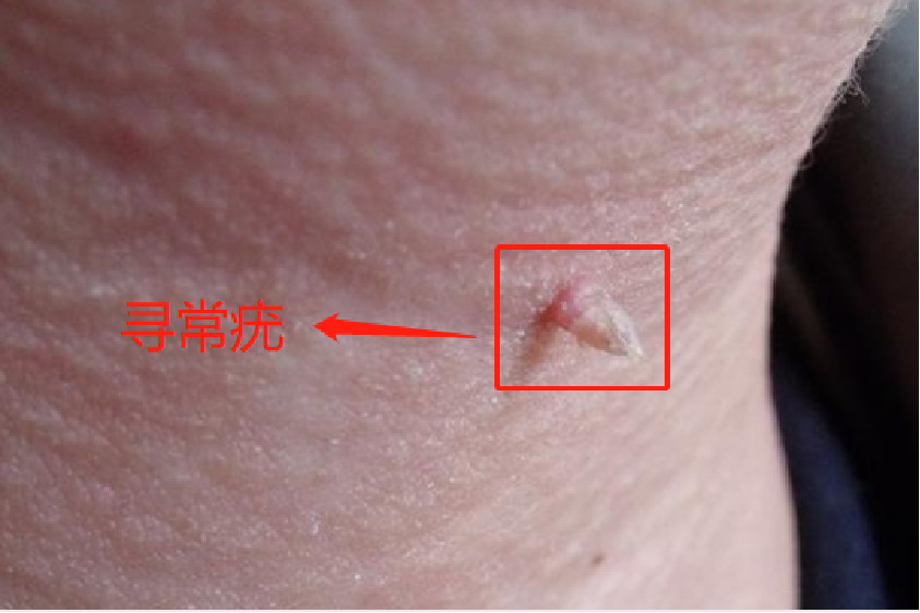 长在腋窝的疣体图片