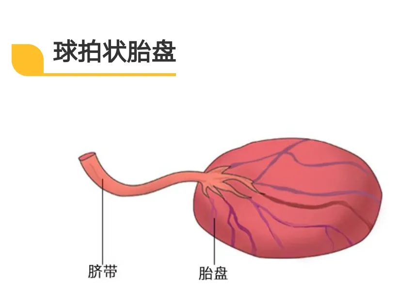 球拍状胎盘的图片 | 百度健康·医学科普