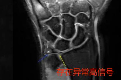TFCC损伤核磁共振图解