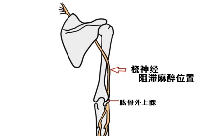 桡神经阻滞麻醉示意图