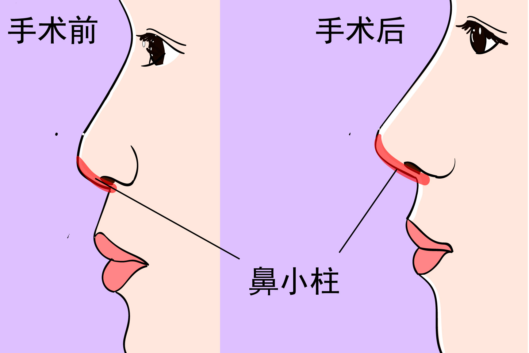 【凸嘴、鼻小柱基底凹陷、鼻唇角的改善方法】整形医生蒋立分享 - 知乎