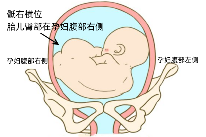 胎位RST位置示意图