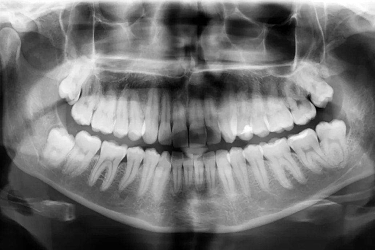 牙槽骨X线图