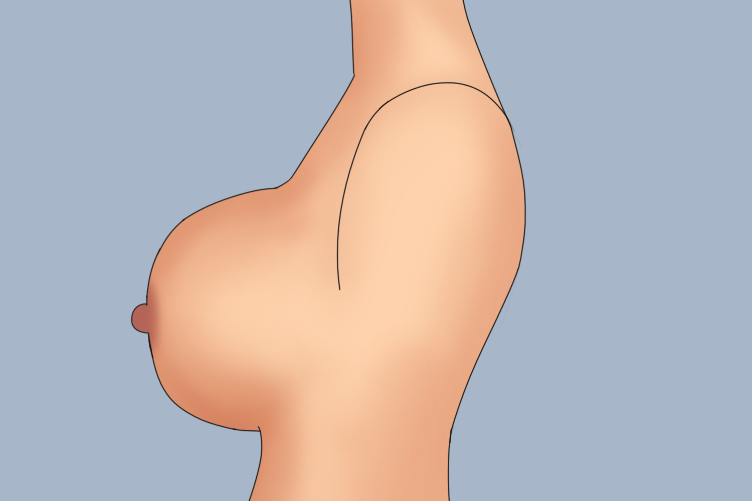 半球型乳房图