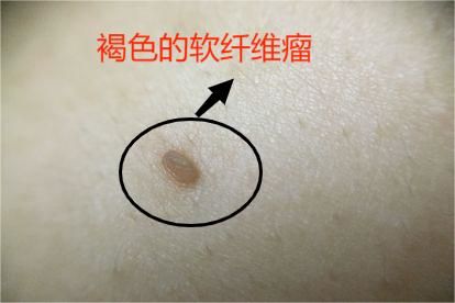 肉粒和疣的区别图片 | 百度健康·医学科普