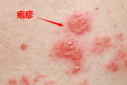 皮肤上各种疹子的图片和名称 | 百度健康·医学科普