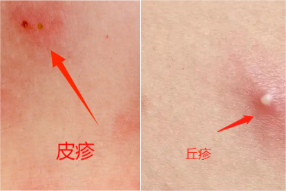 丘疹和皮疹的区别图片 | 百度健康·医学科普
