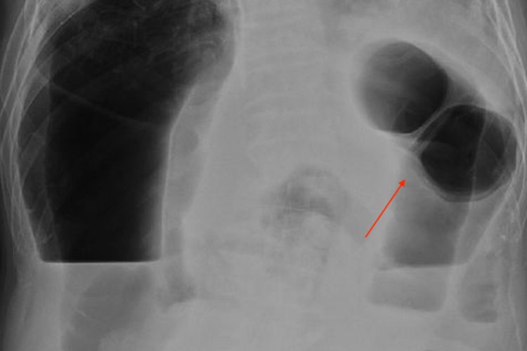 肠梗阻X线液平面图