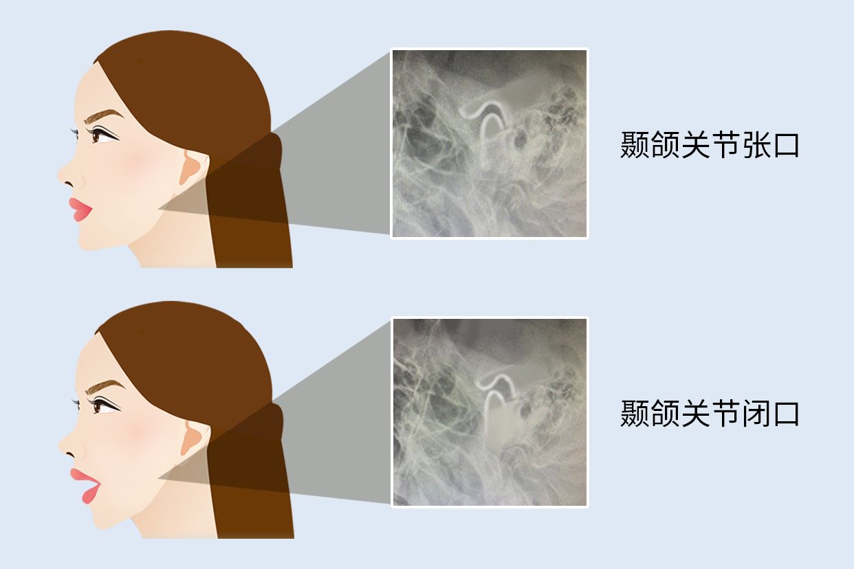 颞颌关节张口闭口位摄影图像 | 百度健康·医学科普