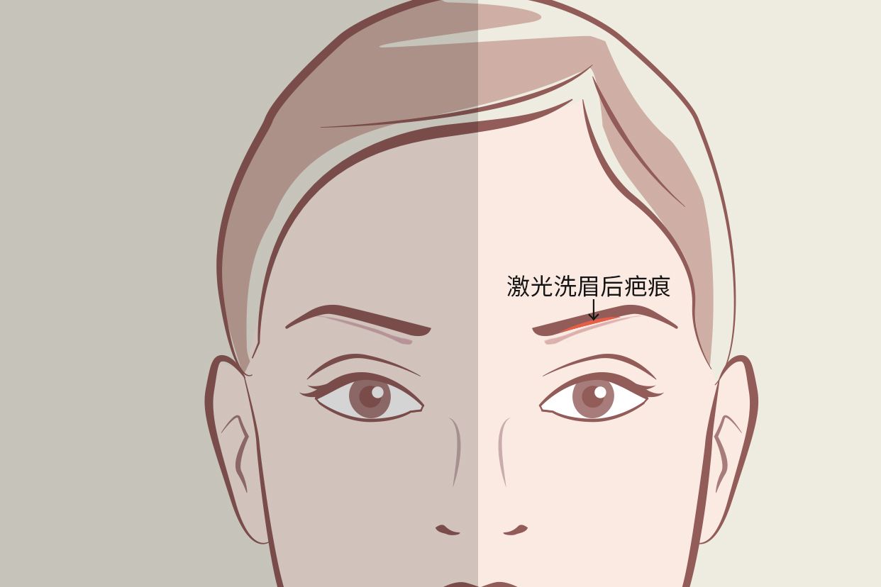 #分享 台北 男生飄眉 眉毛有疤痕 - 美妝板 | Dcard
