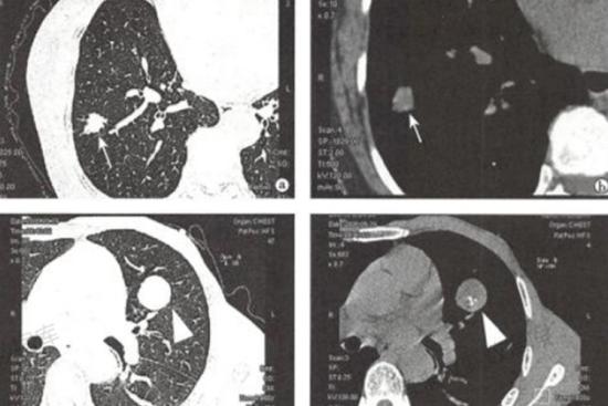 肺结节与肿块CT图