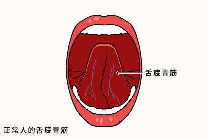 正常人的舌底青筋图片