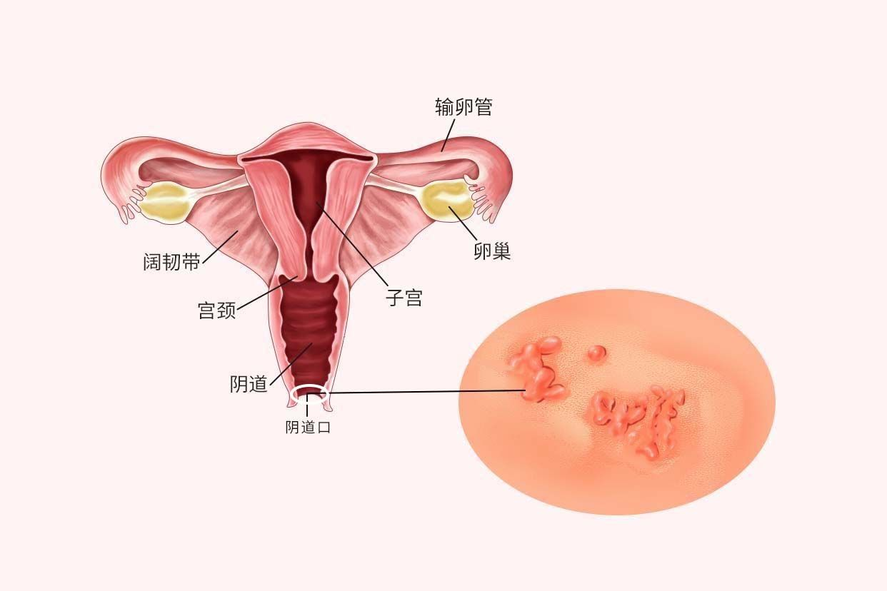 阴道口肉芽图