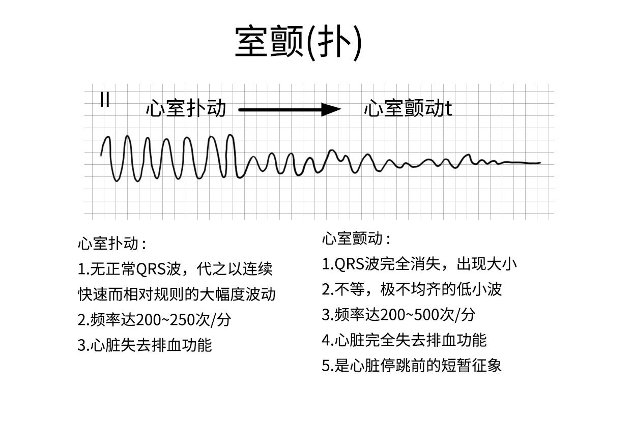 心室扑动和室颤心电图图片