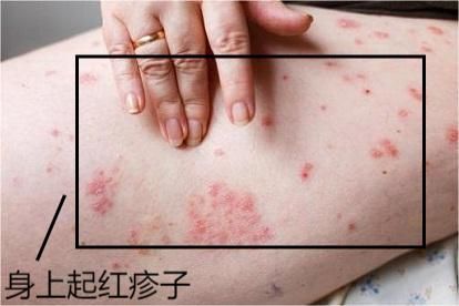 人流后身上起红疹子图片