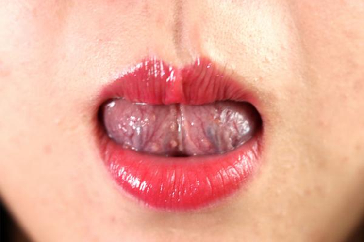 舌下青筋正常图