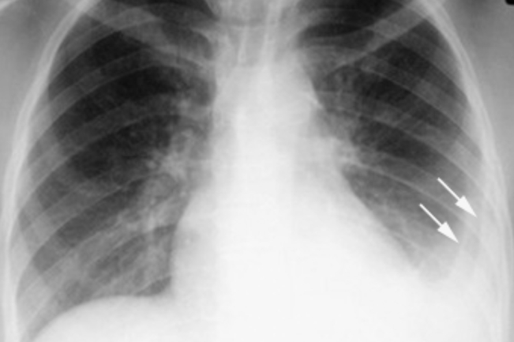 原发性肺结核X线图